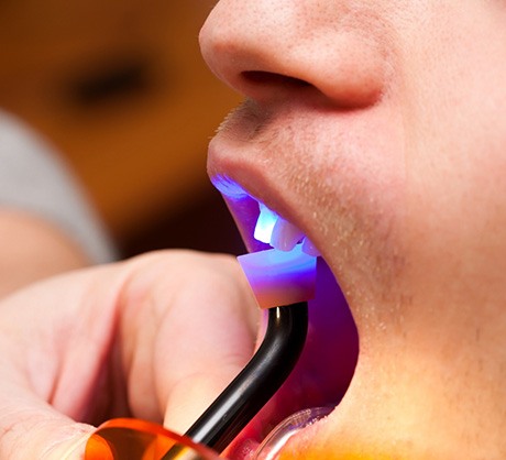 a dentist hardening composite resin with a UV light