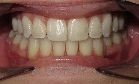 Healthy aligned smile after Invisalign and cosmetic dentistry