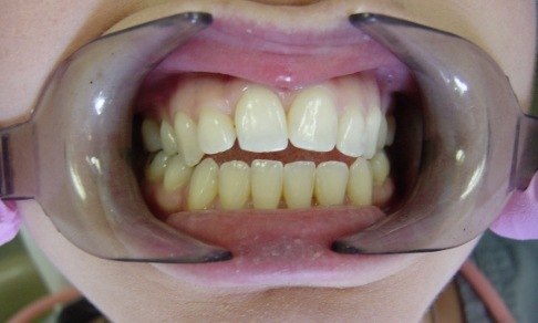 Smile with open bite before Invisalign and cosmetic dentistry