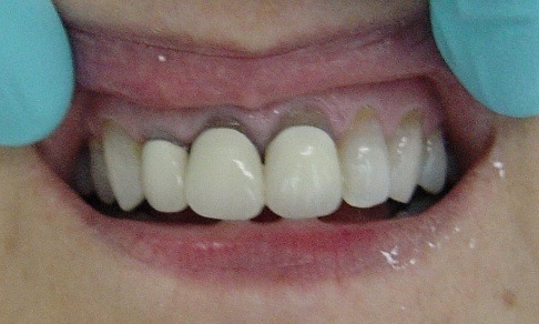 Older dental restoration separating from gum line