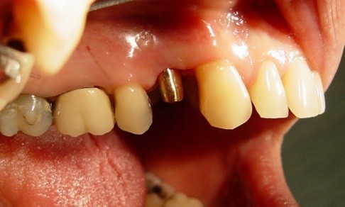 Smile with dental implant post prior to restoration placement