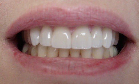 Brilliant white healthy smile after cosmetic dentistry
