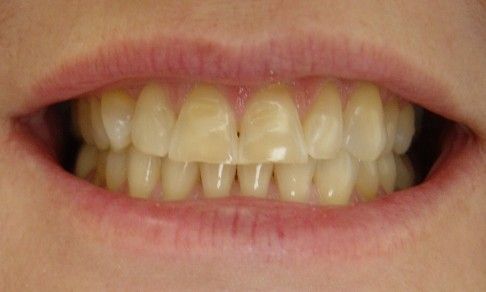 Discolored and damaged smile before cosmetic dentistry