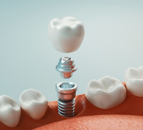illustration showing the parts of a dental implant 
