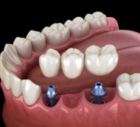 Animated smile during dental implant supported fixed bridge placement
