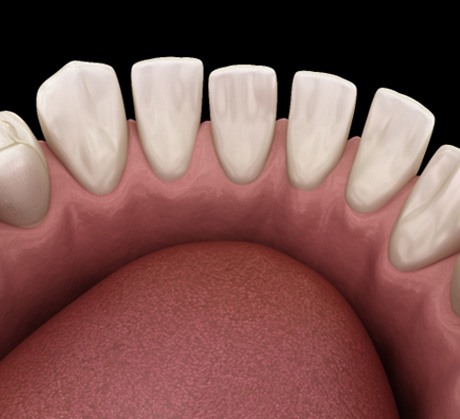 A 3D illustration of excessive spacing between teeth  