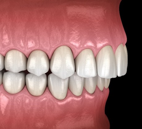 A 3D illustration of a mouth with an overbite  