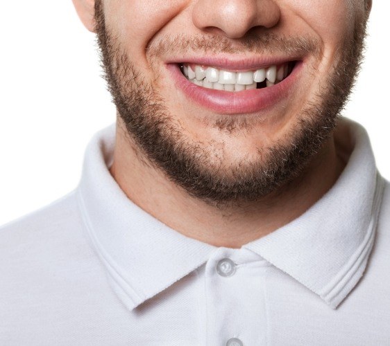 Closeup of incomplete smile before replacing missing teeth