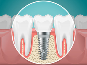 Illustration of a dental implant that has joined with the jawbone